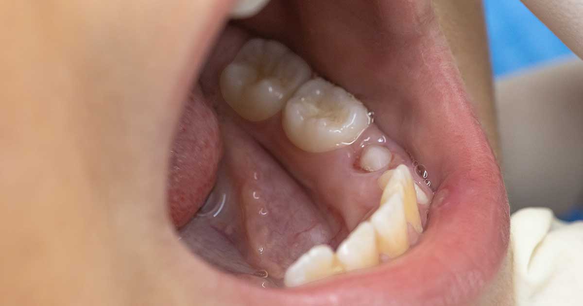molar-definitivo-6-anos